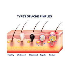 Skin Acne Anatomy Composition