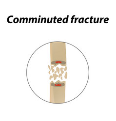 Comminuted Fracture Bone Infographics