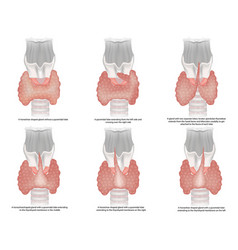 The Classification Of Thyroid