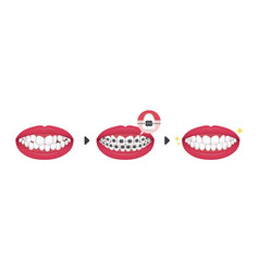 Dental Braces Process No Text