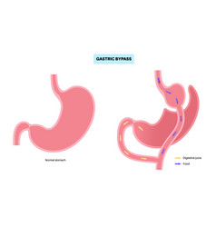 Gastric Bypass Surgery