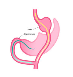 Gastric Bypass Surgery