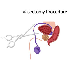 Diagram Showing Vasectomy Procedure