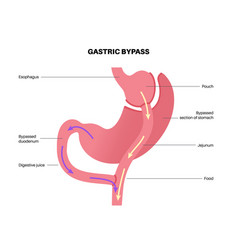 Gastric Bypass Surgery