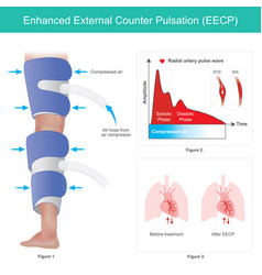 Enhanced External Counter Pulsation A Method