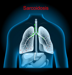 Sarcoidosis Enlarged Lymph Nodes In The Lungs