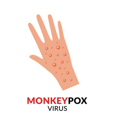 Hand With Monkeypox Rash