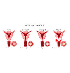 Cervical Cancer Stages Of A Carcinoma Cervix