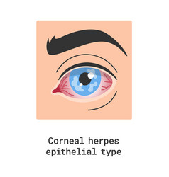 Corneal Herpes Epithelial Eye Disease