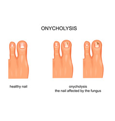 Fungal Nail Infection Onycholysis