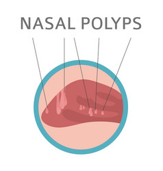 Nasal Diseases Polyps Causes Diagnosis