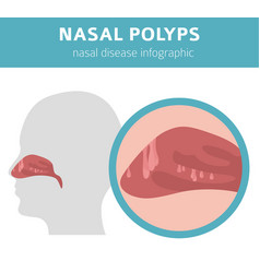 Nasal Diseases Polyps Causes Diagnosis