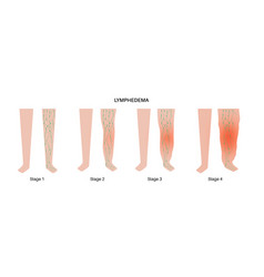 Stages Of Lymphedema