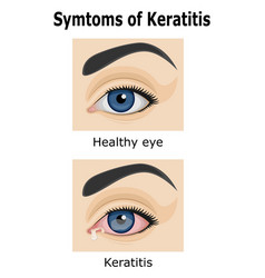 Keratitis