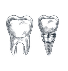 Molar Tooth And Implant Prothesis Sketch