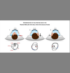 Pagnini Mcclure Roll Test For Canalolithiasis