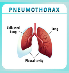 Pneumothorax Diagram With Collapsed Lung