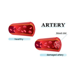 Blood Clot Thrombus Medical Poster