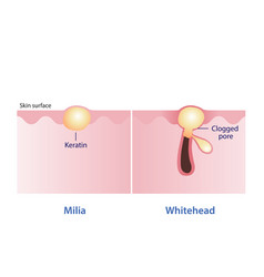 Milia And Whitehead