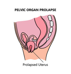 Prolapsed Uterus Women Medical Education