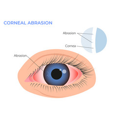 Corneal Abrasion Eye Redness Symptom Pink Red