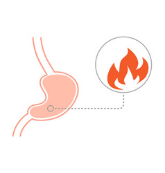 Acid Reflux Disease Concept Human Stomach On Fire