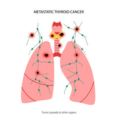 Thyroid Cancer Stages