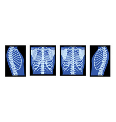 Set Of X-ray Rib Cage Skeleton Human Body - Chest