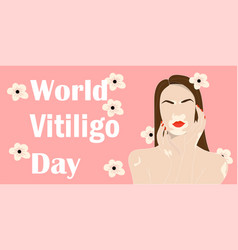 Beauty Woman With Vitiligo