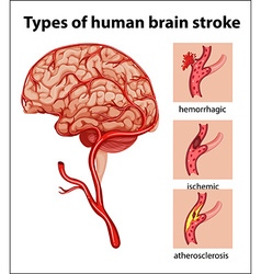 Types Of Human Brain Stroke