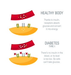 Diabetes Type 1 Concept In Flat Style