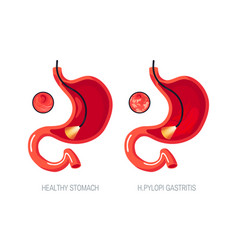 Gastritis Concept In Flat Style Icon