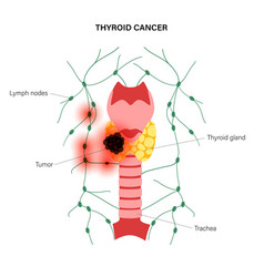 Thyroid Cancer Stages