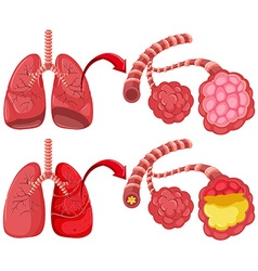 Lung diagram with pneumonia Royalty Free Vector Image