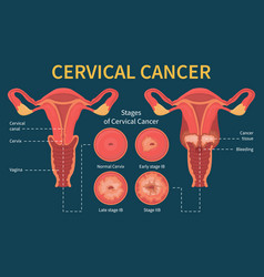 Stages Woman Cervical Cancer Infographic Scheme