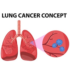 Lung diagram with pneumonia Royalty Free Vector Image