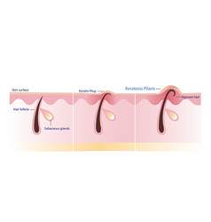 Process Of Keratosis Pilaris