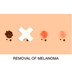 Removal Of Melanoma