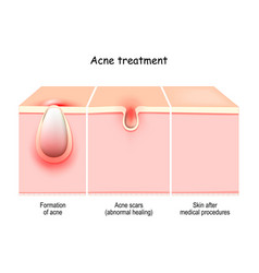 Acne Treatment Cross Section Of A Skin