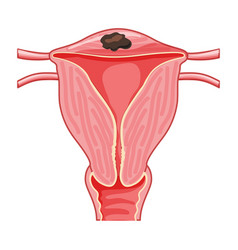 Focal Adenomyosis Human Anatomy Female