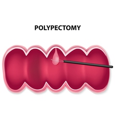 Polypectomy