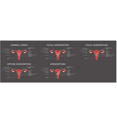 Set Of Adenomyosis Human Anatomy Female