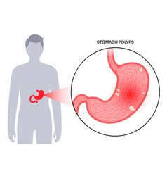 Stomach Polyp Disease