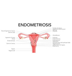 Endometriosis Stages Female Reproductive System