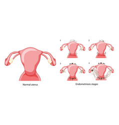 Set Of Endometriosis Stages Female Reproductive