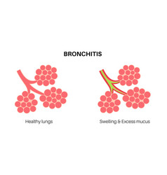 Bronchitis Lung Disease