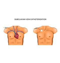 Subclavian Vein Catheterization