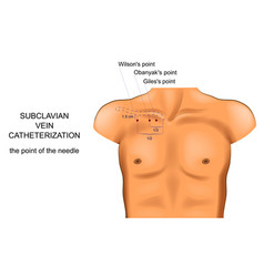 Subclavian Vein Catheterization Access Point