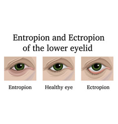 Entropion And Ectropion Lower Eyelid