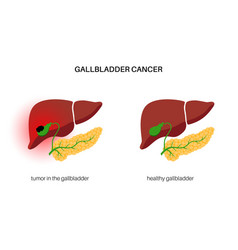 Gallbladder Cancer Anatomy